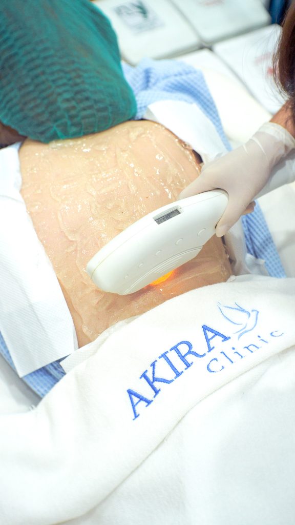 IPL E-Light Max at Akira Clinic