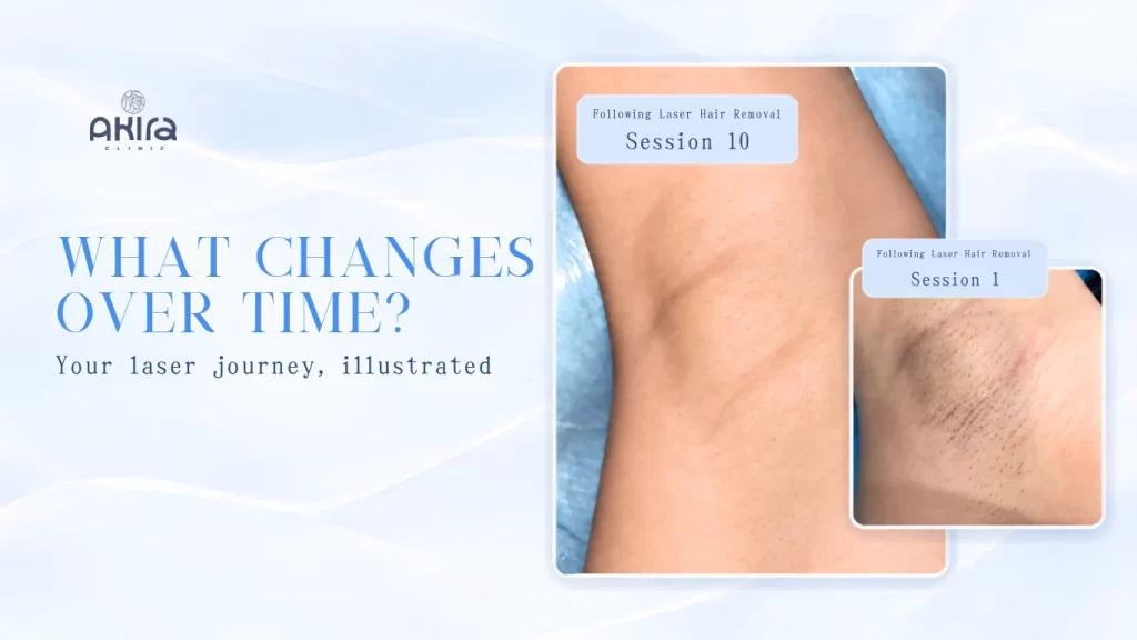 Underarm Laser: What to Expect